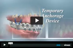 Temporary Anchorage Device