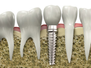 dental implants Dubuque