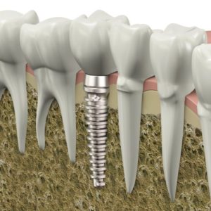 implant dentistry Dubuque